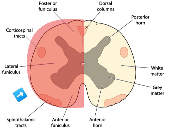 graphic showing location of lesion in brown-sequard syndrome