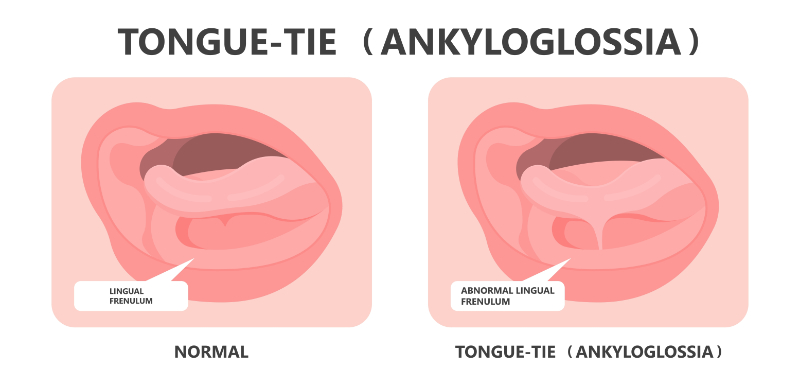 graphic showing tongue tie