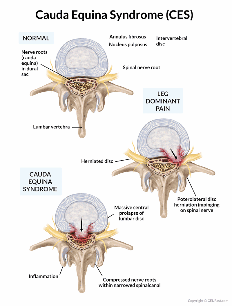 graphic of cauda equina syndrome (CES)