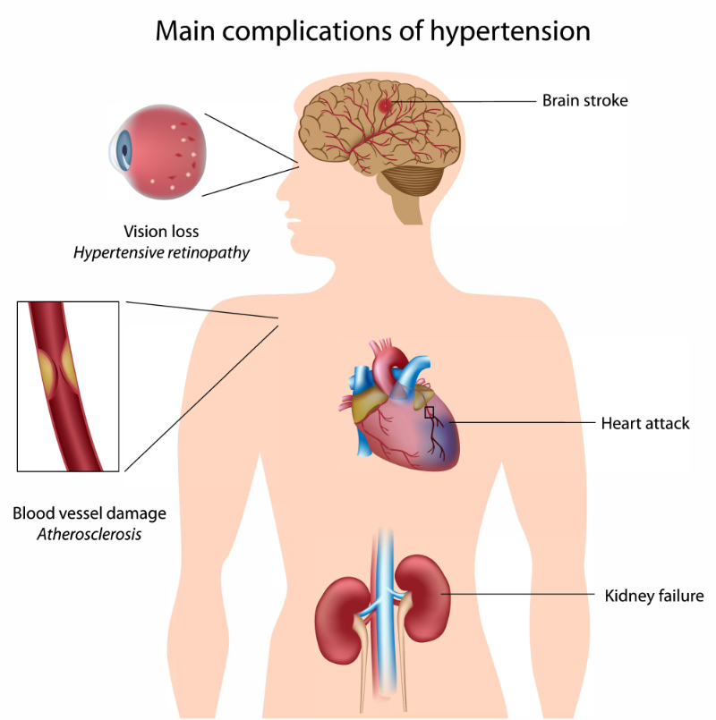 graphic showing the main complications of hypertension in human body