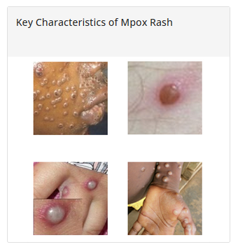 photo showing characteristics of mpox