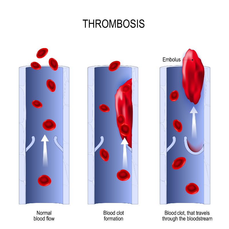 graphic showing thrombosis