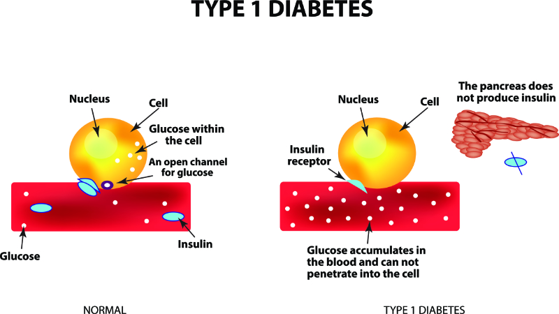graphic showing type 1 diabetes