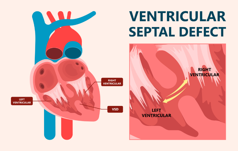 graphic showing ventricular septal defect