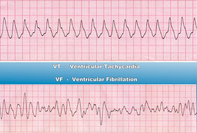 ventricular tachycardia v.s. ventricular fibrillation image