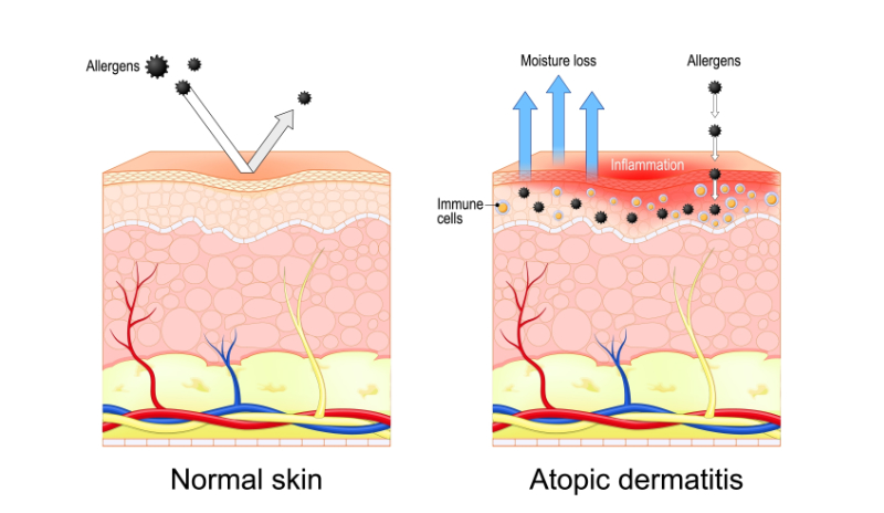 graphic showing atopic dermatitis