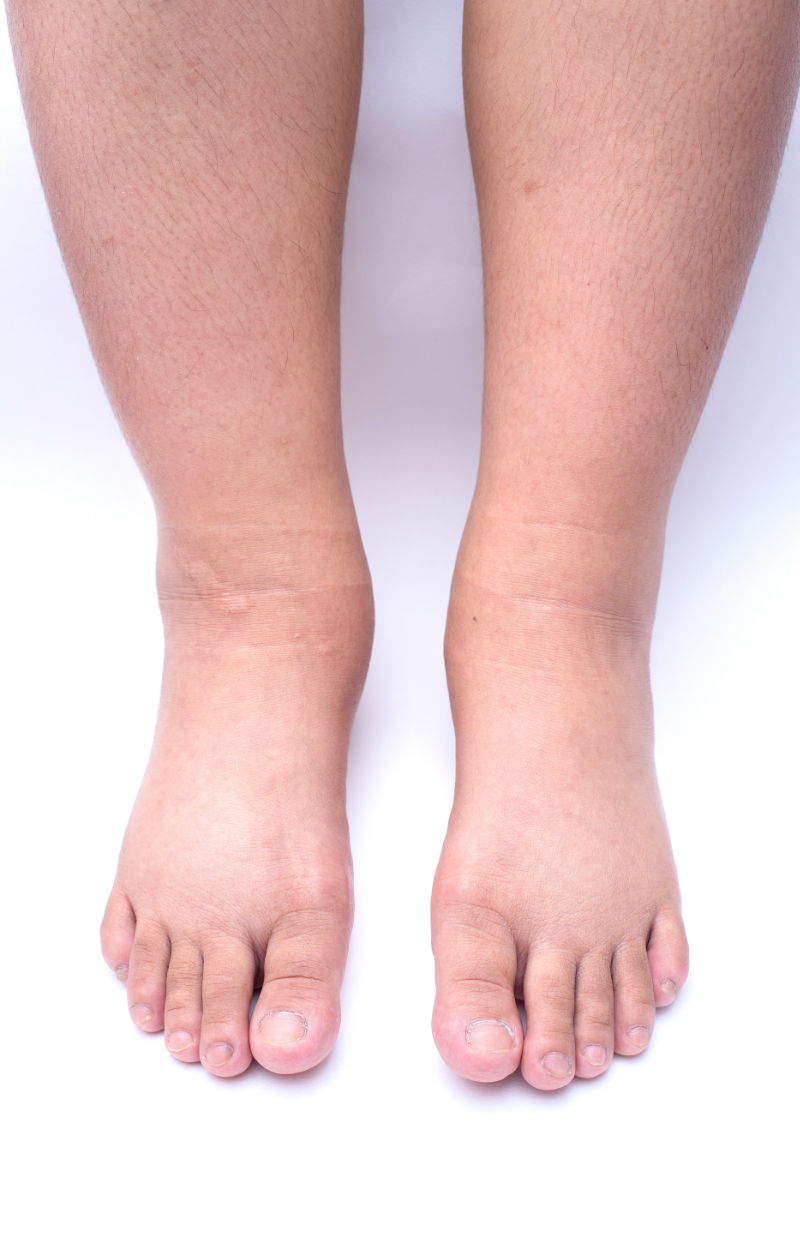 photo of gbilateral lymphedema on legs