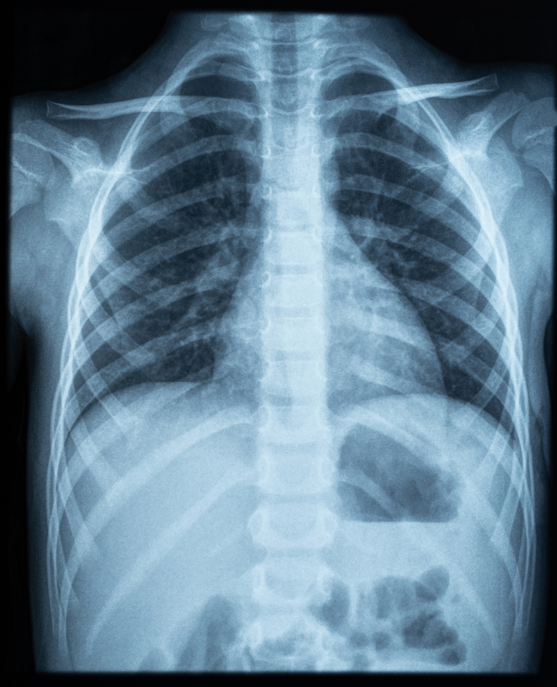 photo of chest x-ray