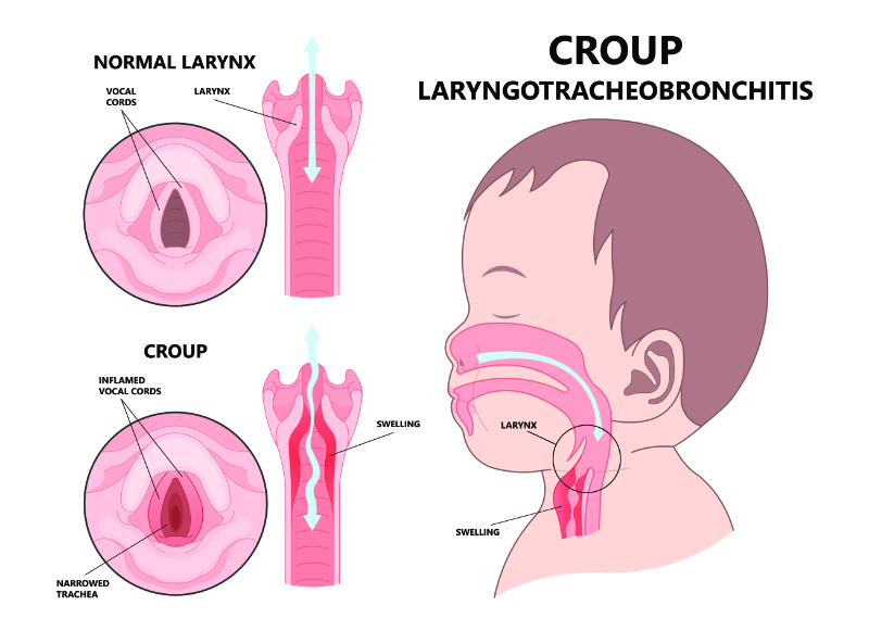 graphic showing labeled view of child with croup