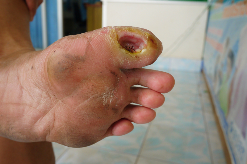 photo of diabetic foot ulcer