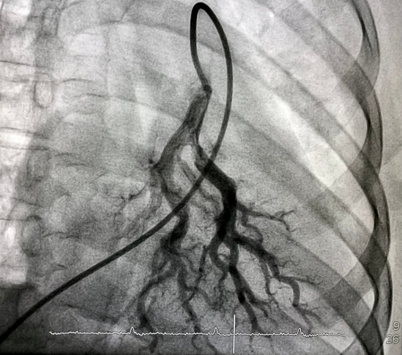 xray view of pulmonary angiogram