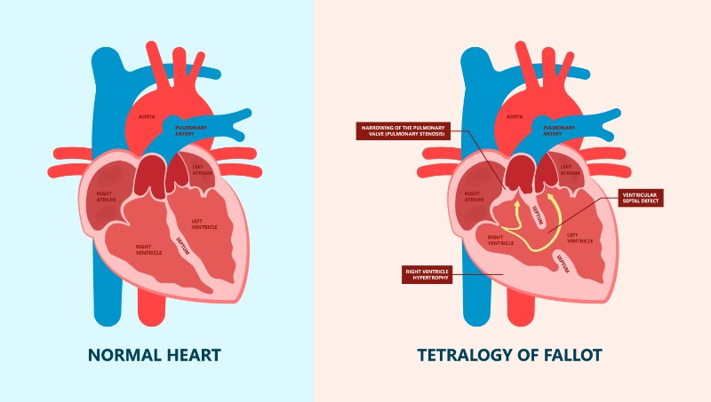graphic of tetralogy of follot