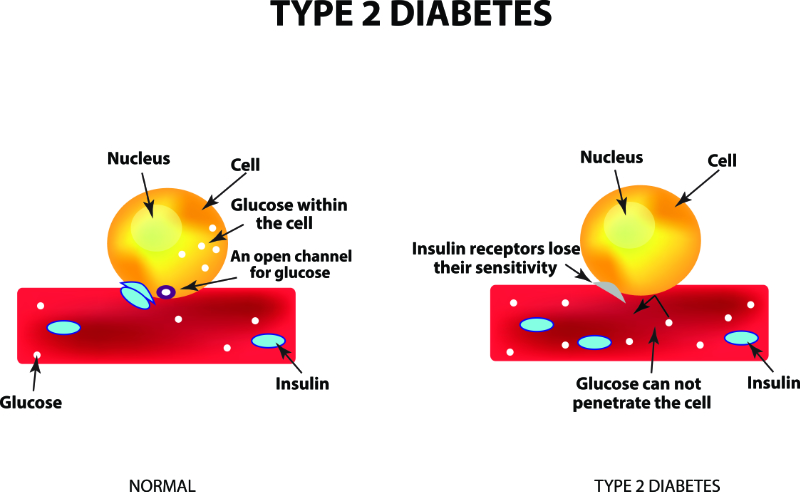 graphic showing type 2 diabetes