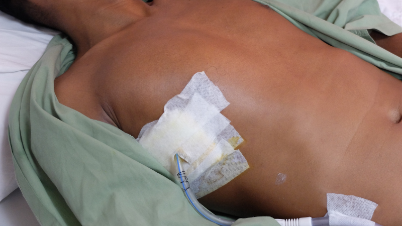 photo of patient with chest tube