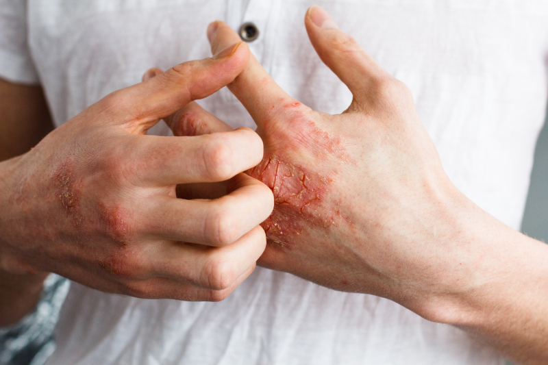 photo of man with eczema on hands
