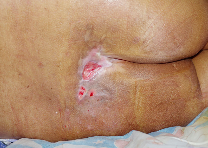 photo of kennedy terminal ulcer