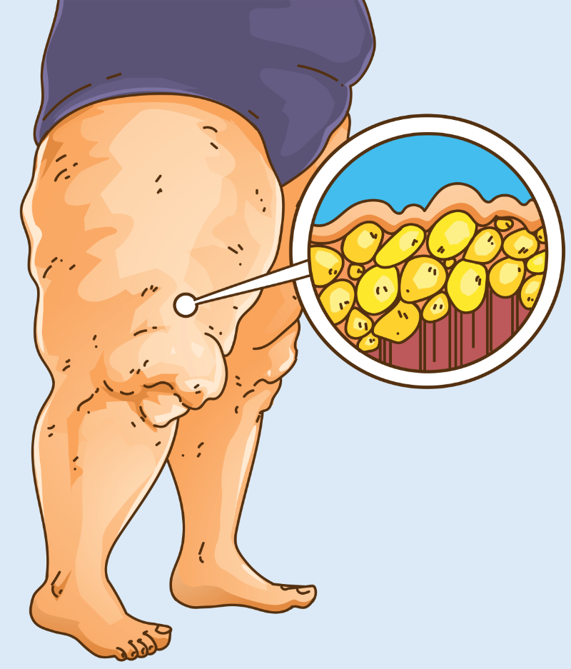 graphic showing lipedema on the leg
