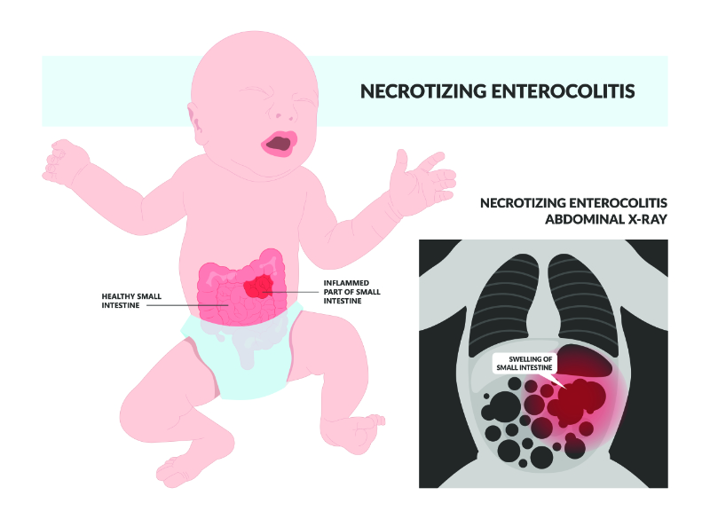 graphic showing necrotizing enterocolitis