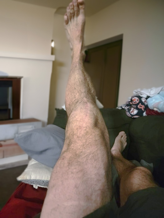 photo of mans quadriceps following rehab
