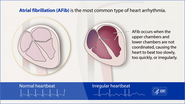 atrial_fibrillation