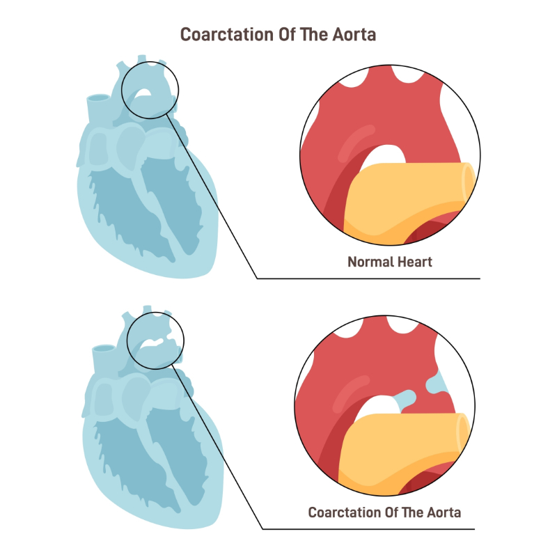 graphic showing coarctation of the aorta