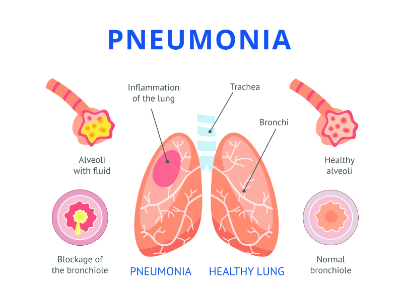 graphic showing a labeled view of lungs with pneumonia