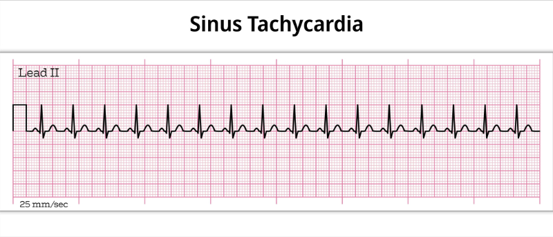 image of sinus tachycardia