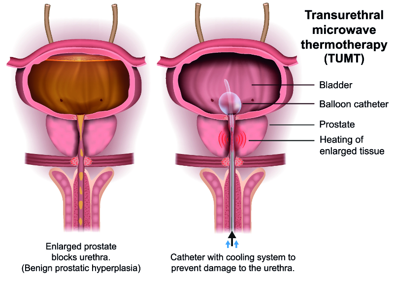 graphic showing TUMT