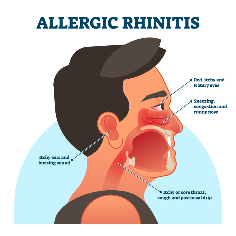 graphic showing labeled allergic rhinitis