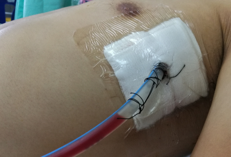 photo of patient with chest tube