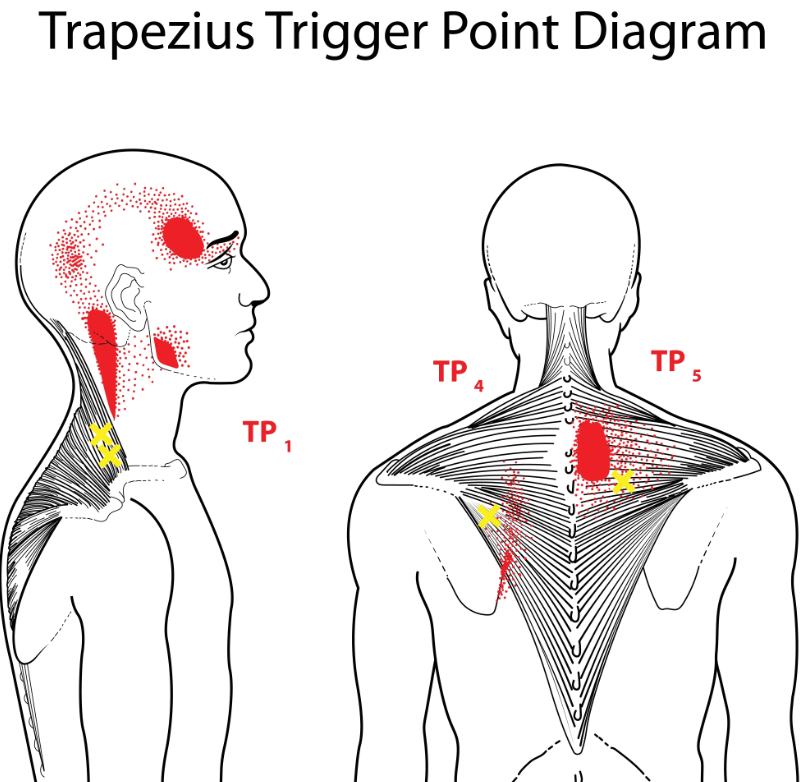 graphic showing trigger points