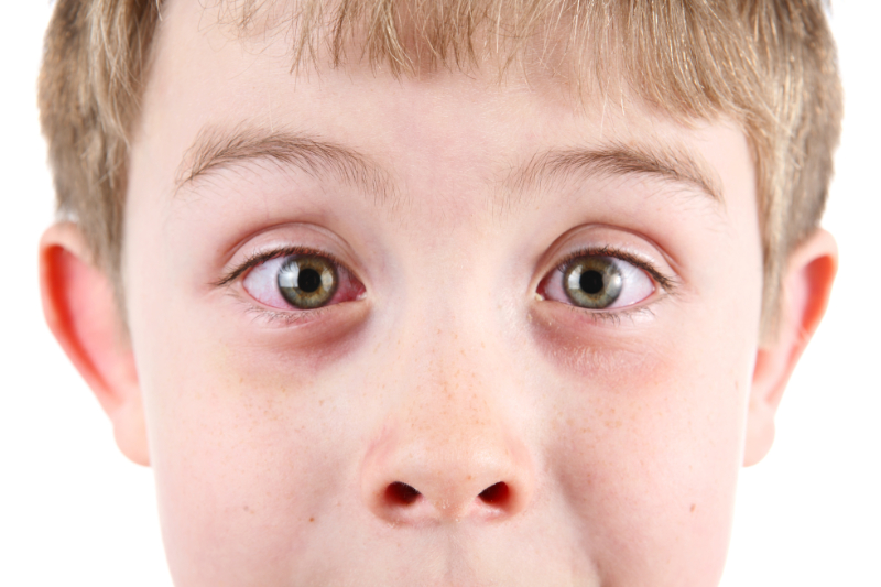 photo of male boy with allergic shiners