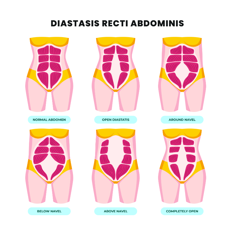 graphic showing diastasis recti abdominis