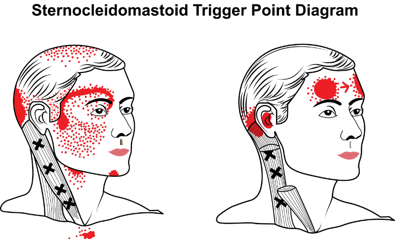 graphic showing trigger points