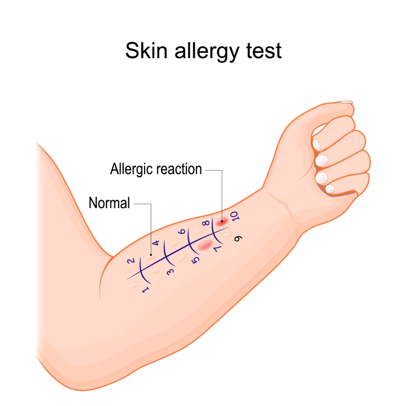 graphic showing skin allergy test on arm