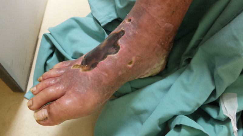 photo of arterial ulcer