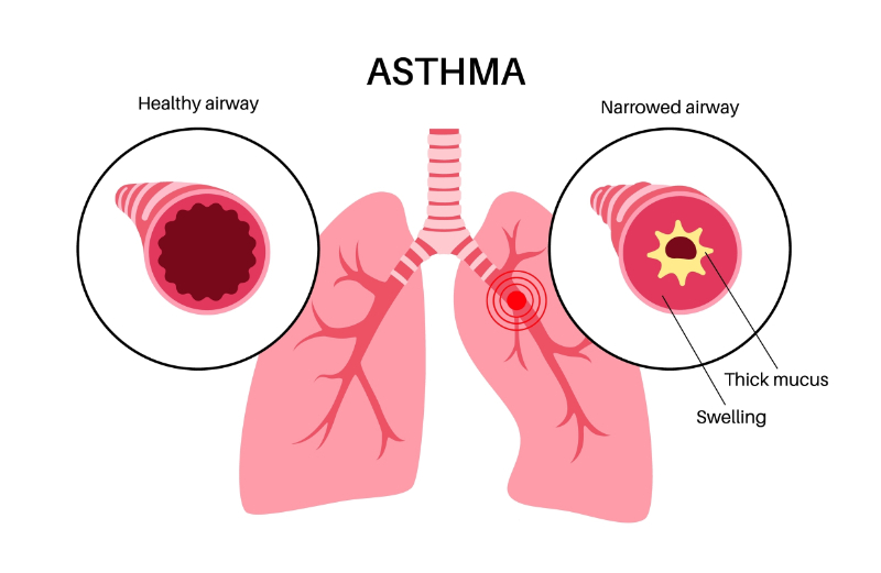 graphic of the lungs showing asthma