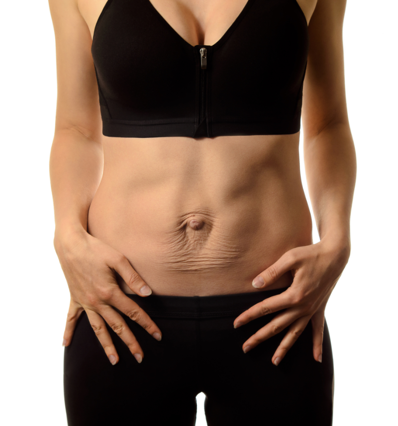 photo of diastasis recti abdominus