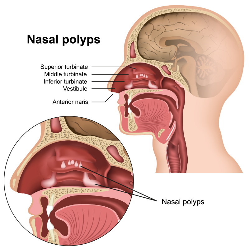 graphic showing labeled nasal polyps