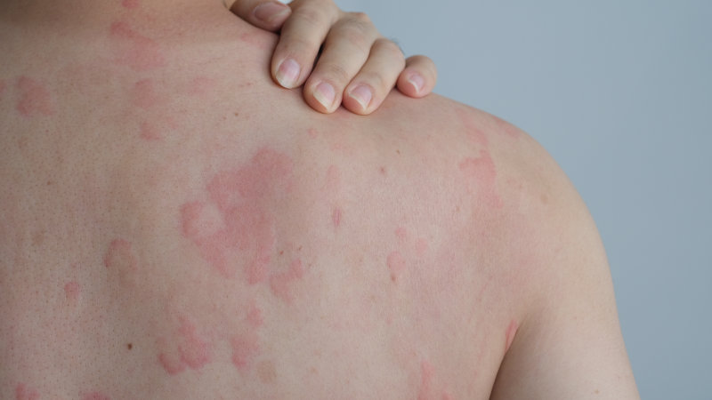 photo of urticaria skin condition