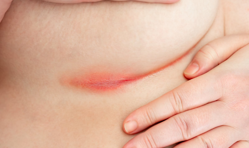 photo of erythema intertrigo