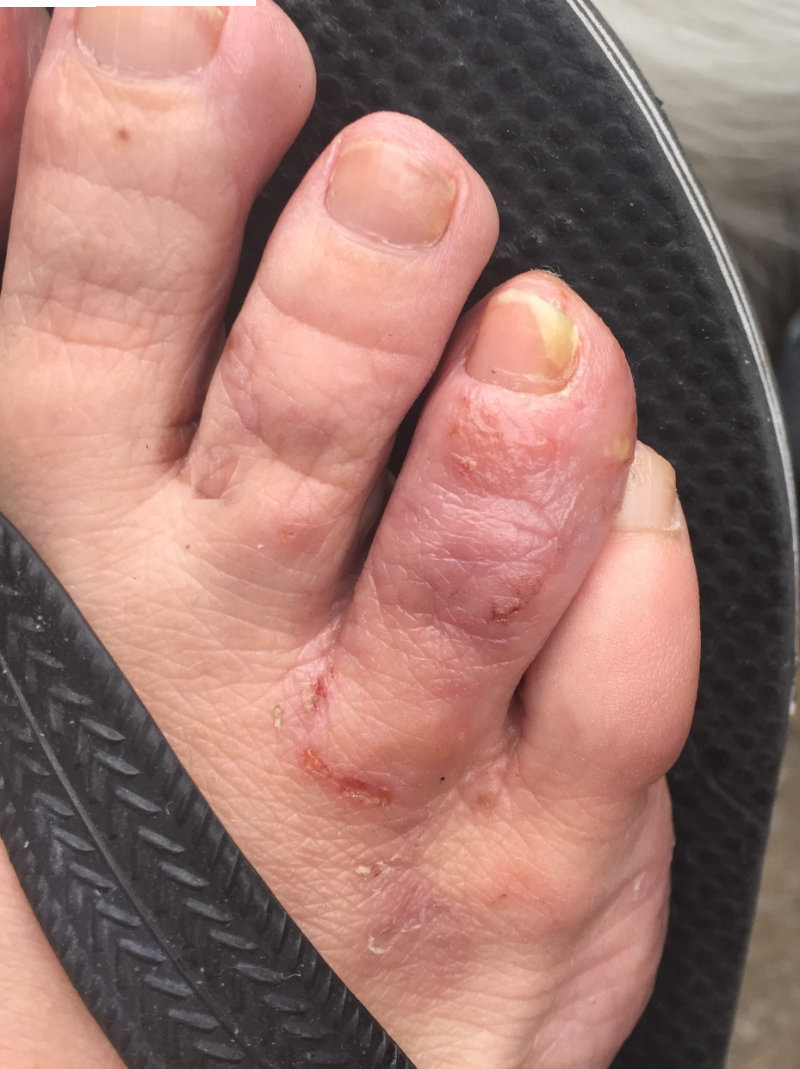 photo of sarcoptes scabiei scabies