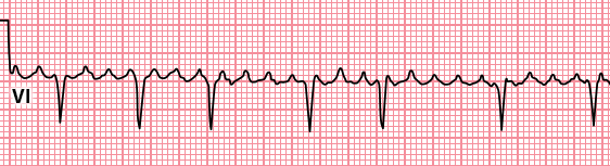 atrial_flutter_variable_conduction