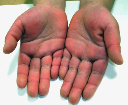 Indurated Edema of the Dorsum of the Hands as seen in Kawasaki Disease