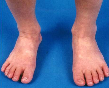 Characteristic Periungual Desquamation of the Hands and Feet