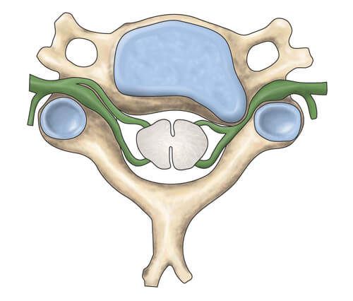 Disk material pressing on spinal nerve