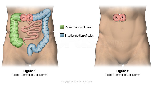 graphic showing loop barrel transverse colostomy