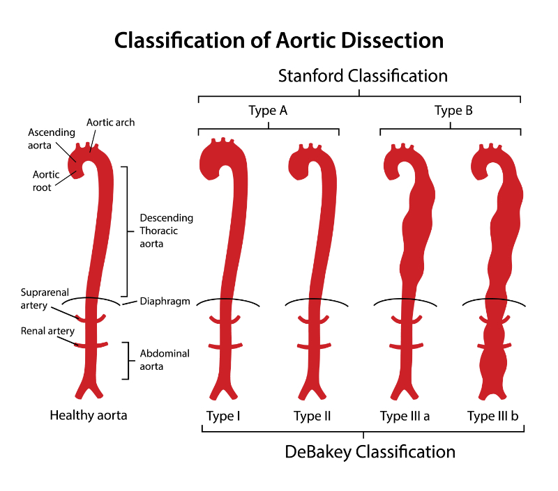 classification_of_aortic_dissection