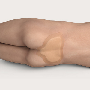 photo of silicone dressing on patient