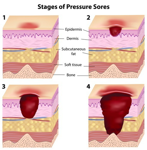 graphic showing stages of pressure sores